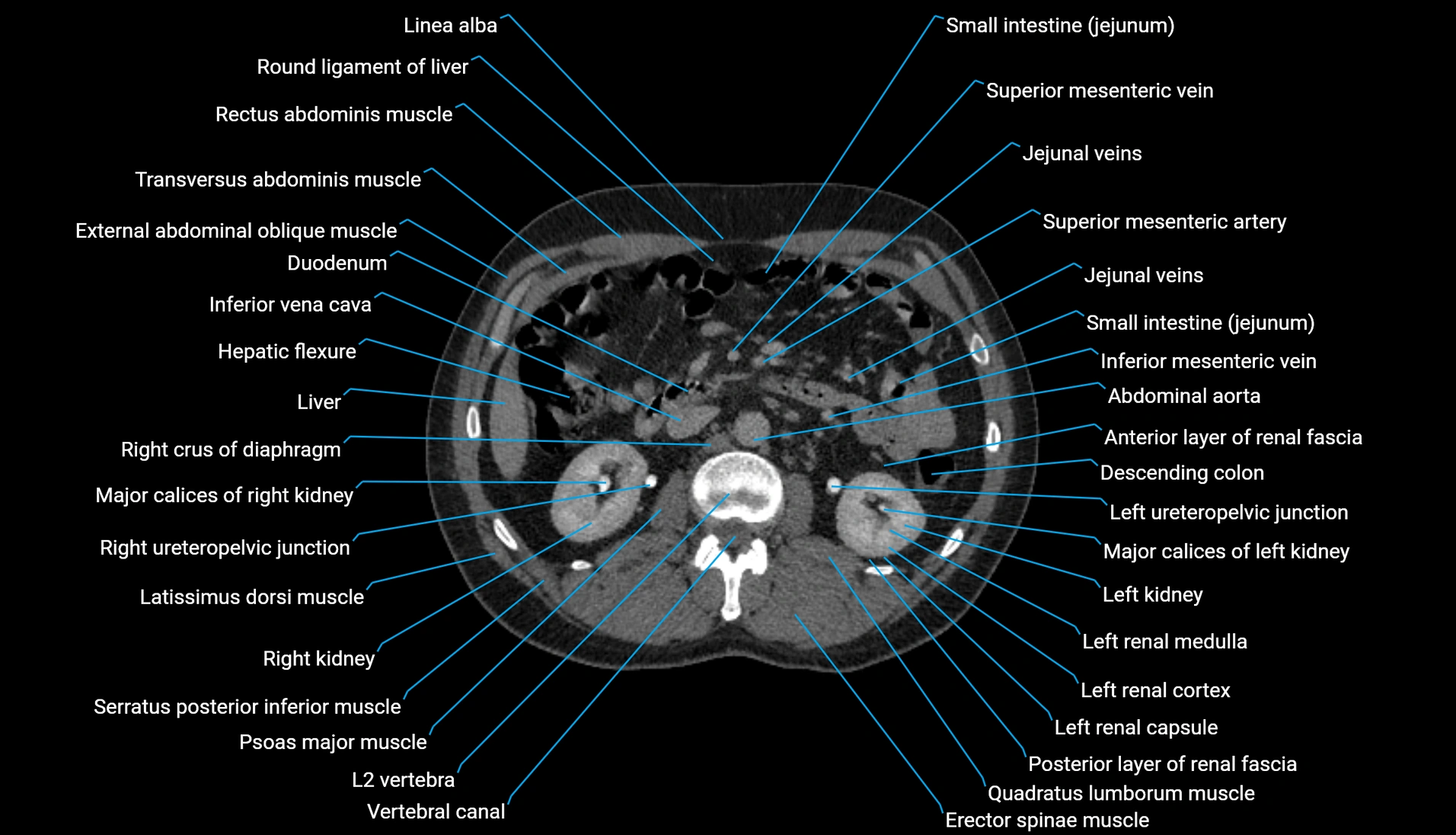 CT urogram axial cross sectional anatomy  labelled radiology image-00108.webp